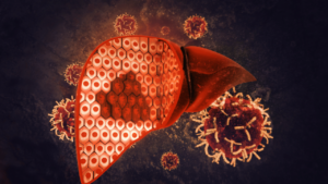 Carcinome hépatocellulaire