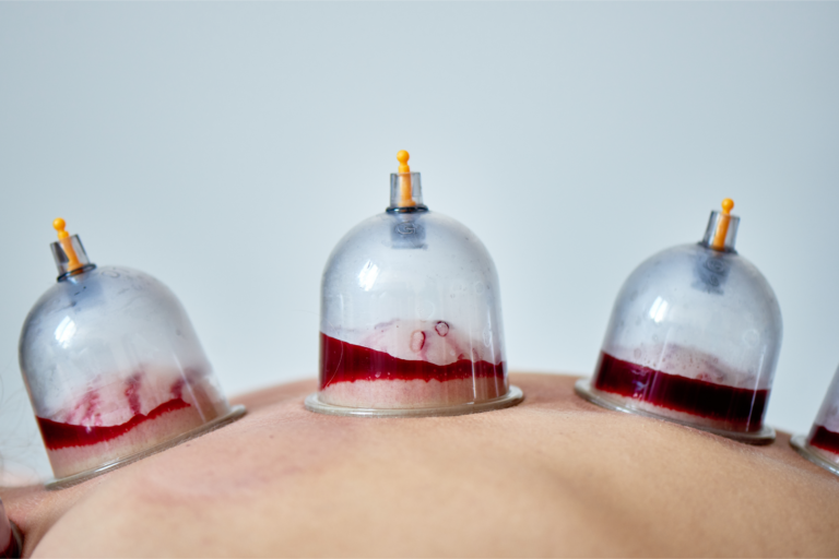 Hijama sang noir signification