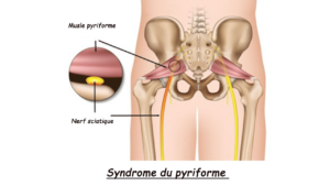 Syndrome piriforme (fessalgie inflammatoire)