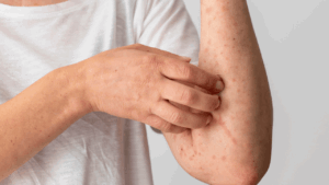 Photo Pityriasis rosé de Gibert