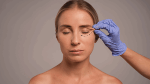 blépharoplastie