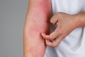 Irritations cutanées
