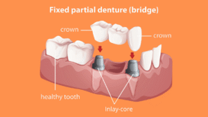 inlay-core dentaire
