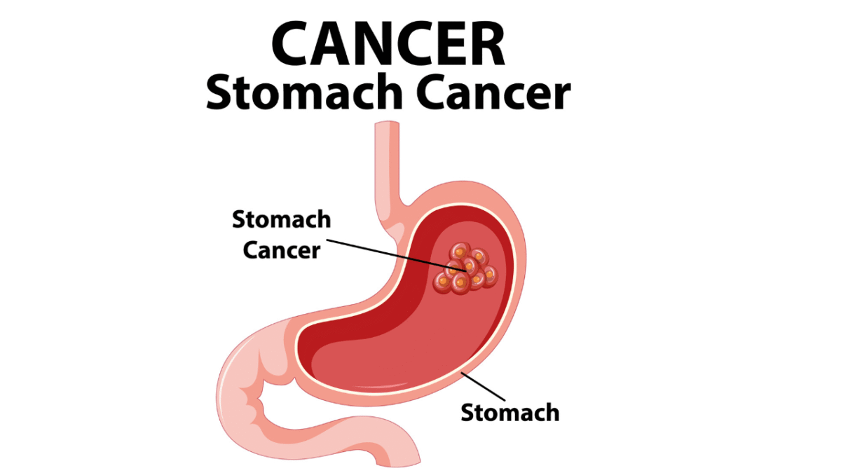 Cancer de l'estomac Causes, manifestations et traitements — free download